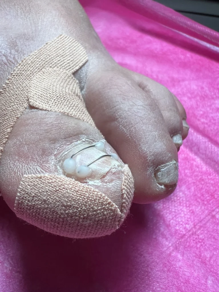 medical-pedicure-kassandra-nails